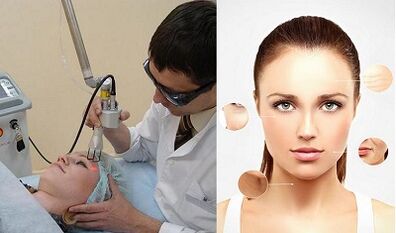 Kumaha rejuvenation kulit laser dipigawé